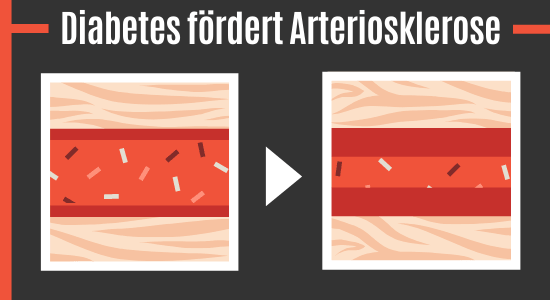 Diabetes fördert Arteriosklerose