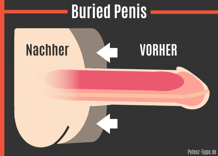 Körperfett verlieren gegen einen Buried Penis