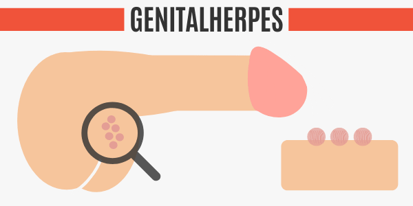 Genitalherpes am Hoden