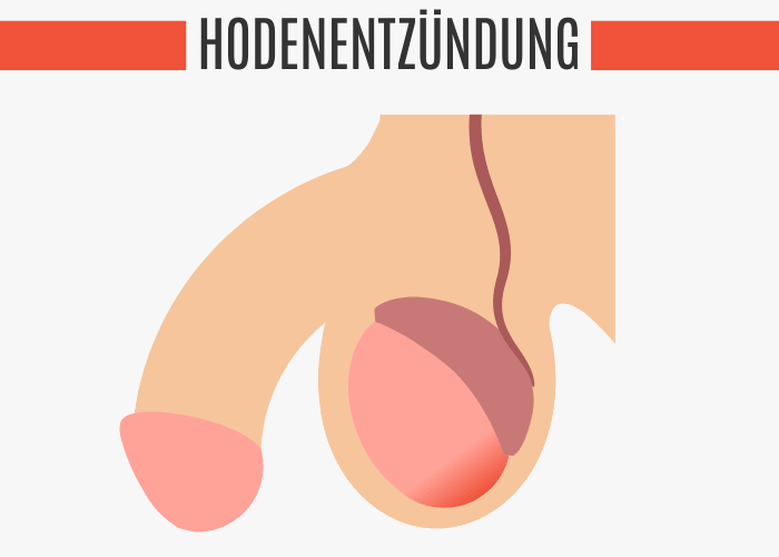Hodenentzündung