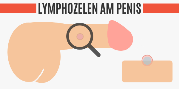 Lymphozelen am Penis