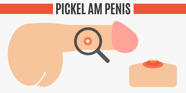 Penis eiterpickel auf Penis