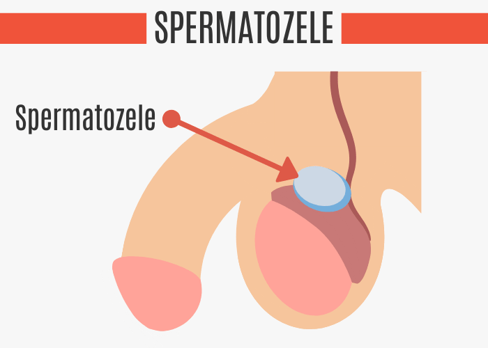 Spermatozele
