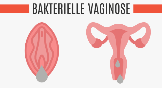 Bakterielle Vaginose