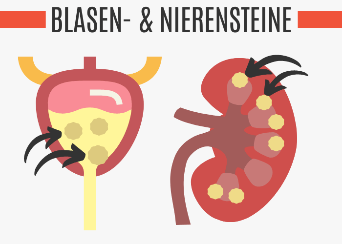 Blasensteine und Nierensteine
