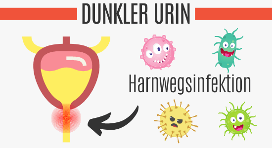 Dunkler Urin durch Harnwegsinfektion