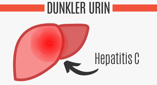 Hepatitis C führt zu dunkelgelben Urin