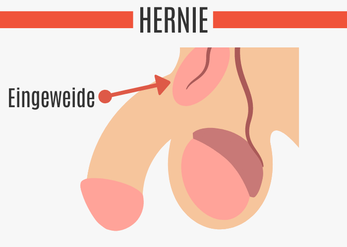 Hernie