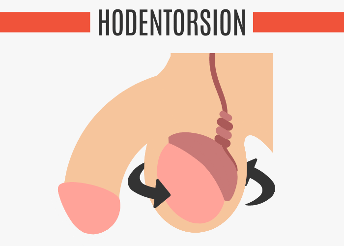 Hodentorsion