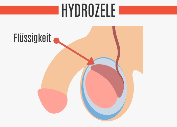 Op schwellung hydrozele Hydrozele (Wasserbruch):