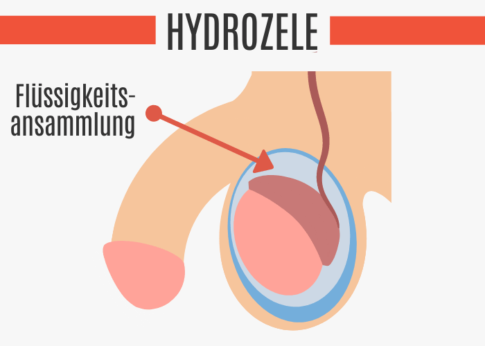 Hydrozele