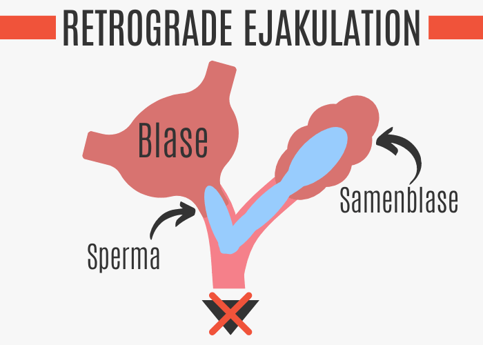 Retrograde Ejakulation