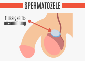 knoten am hoden 7 ursachen mit bilder 2023 potenz tipps für männer