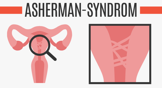 Asherman-Syndrom