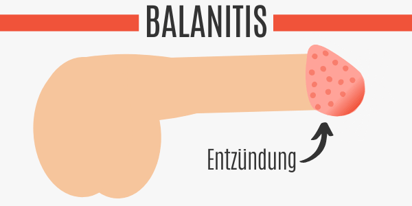 Penis entzündung Balanitis •
