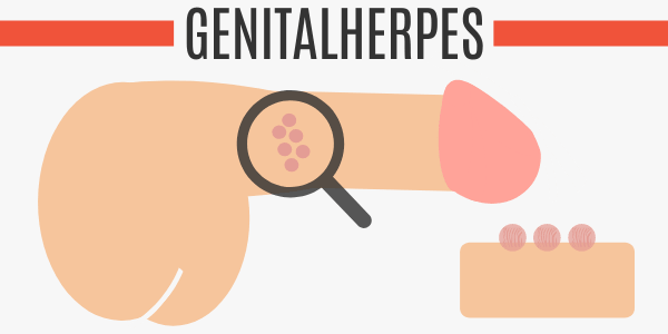Genitalherpes