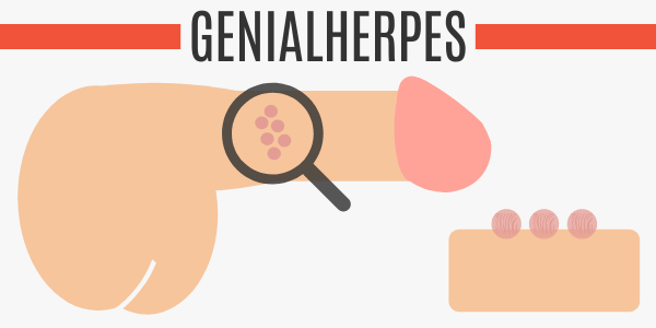 Genitalherpes