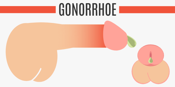 Gonorrhoe