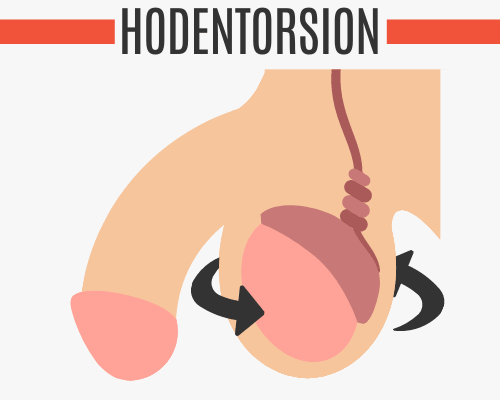 Hodentorsion