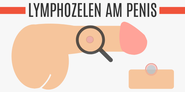 Lymphozelen am Penis