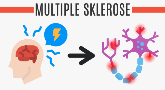 Multiple Sklerose vs. Nerven