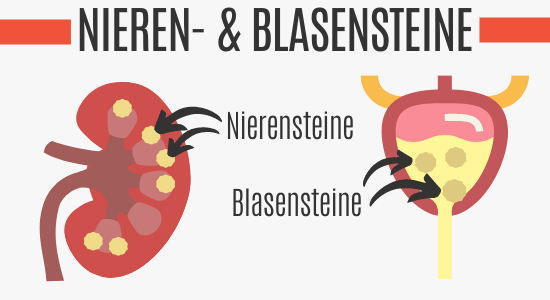 Nierensteine und Blasensteine