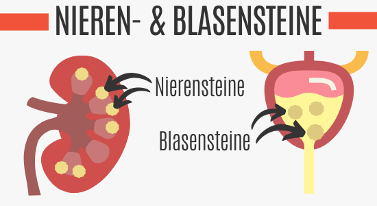 Nieresteine und Blasensteine
