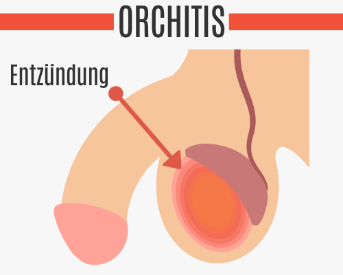 Orchitis