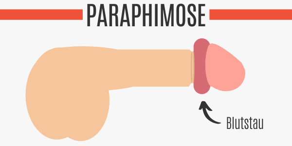 Paraphimose