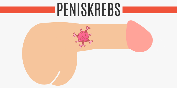 Peniskrebs