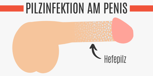 Pilzinfektion am Penis