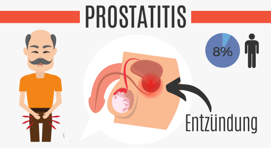 késleltetett ejakulációs prosztatitis
