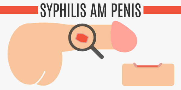 Syphilis am Penis