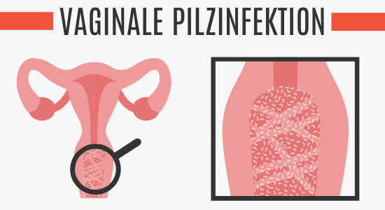 Vaginale Pilzinfektion